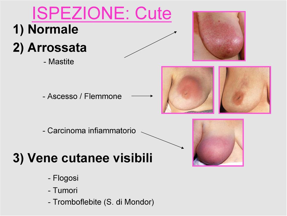 infiammatorio 3) Vene cutanee visibili -