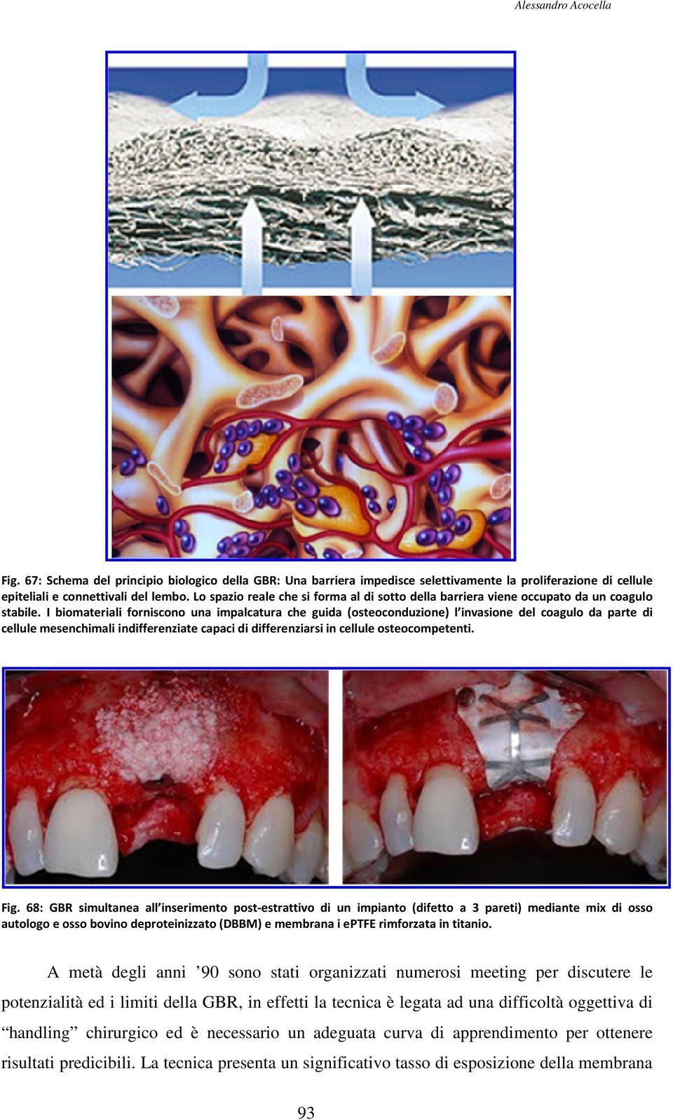 I biomateriali forniscono una impalcatura che guida (osteoconduzione) l invasione del coagulo da parte di cellule mesenchimali indifferenziate capaci di differenziarsi in cellule osteocompetenti. Fig.