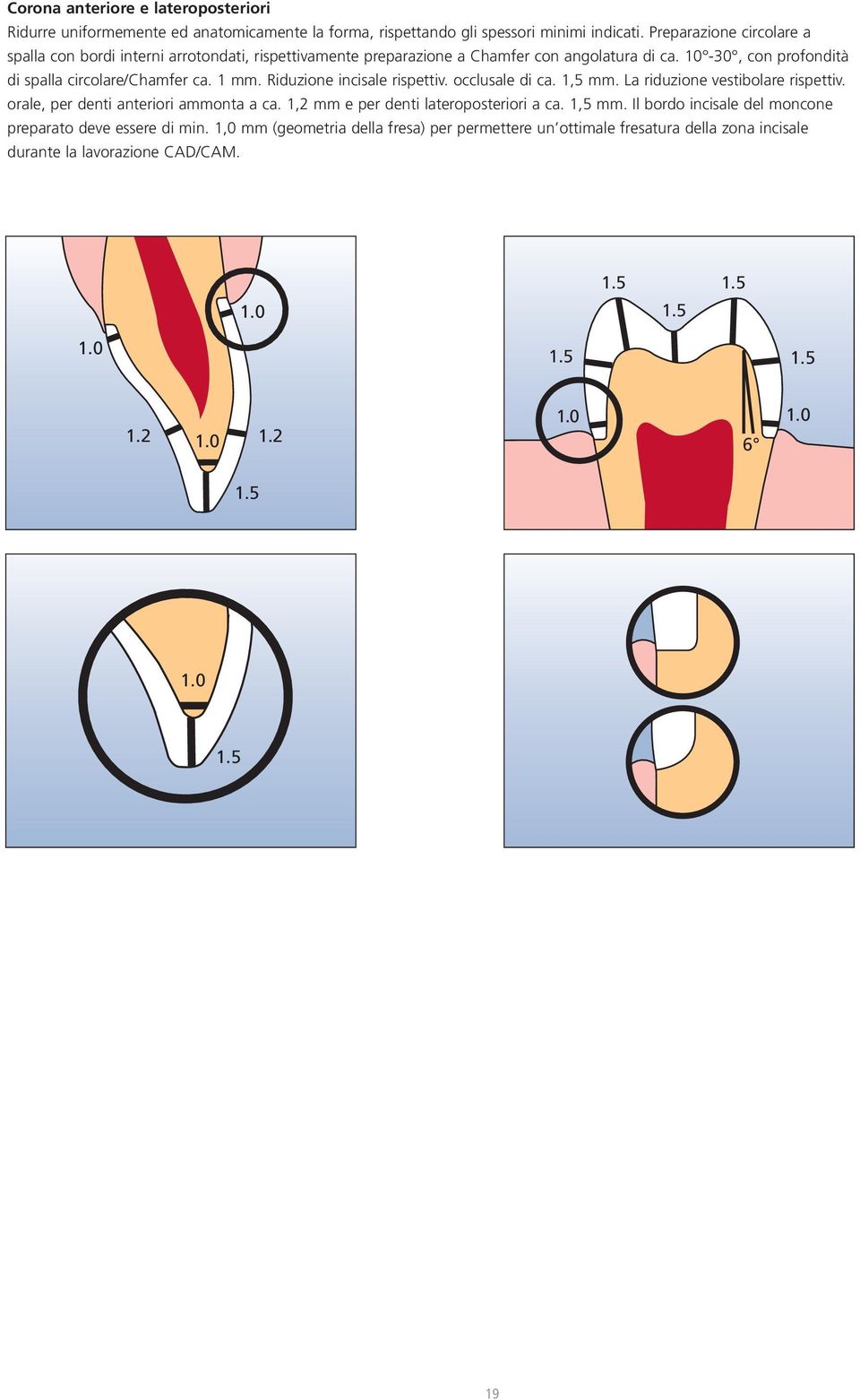 Riduzione incisale rispettiv. occlusale di ca. 1,5 mm. La riduzione vestibolare rispettiv. orale, per denti anteriori ammonta a ca. 1,2 mm e per denti lateroposteriori a ca. 1,5 mm. Il bordo incisale del moncone preparato deve essere di min.