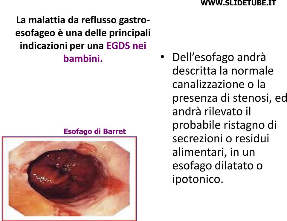 Esofago di Barret Dell esofago andrà descritta la normale canalizzazione o la