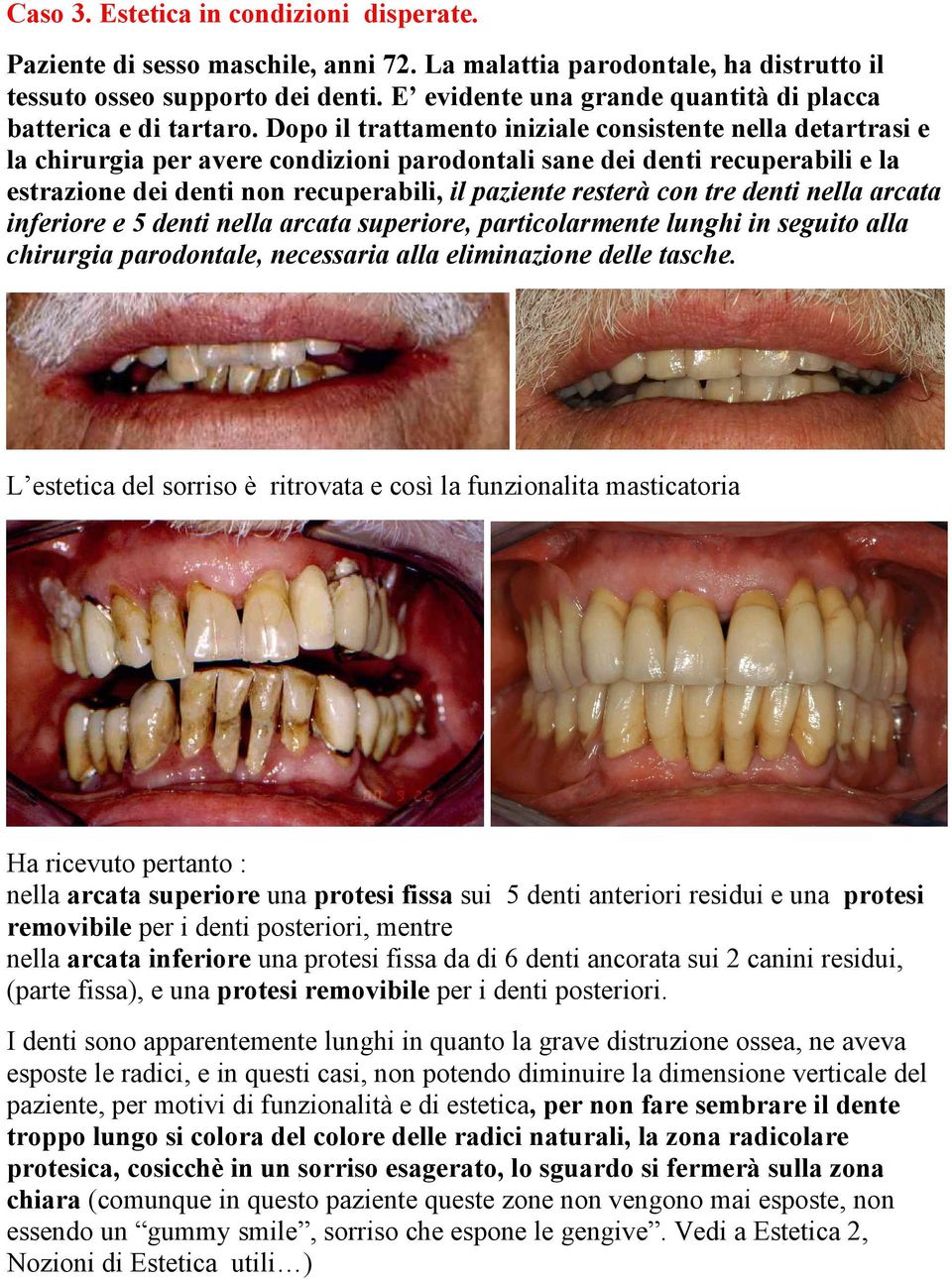 Dopo il trattamento iniziale consistente nella detartrasi e la chirurgia per avere condizioni parodontali sane dei denti recuperabili e la estrazione dei denti non recuperabili, il paziente resterà