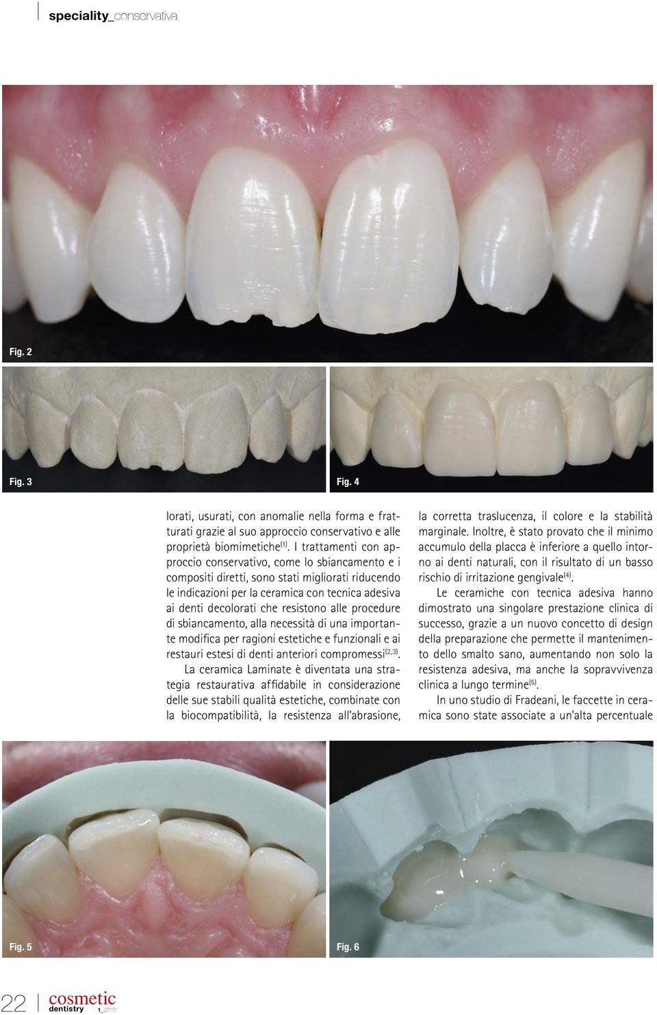 resistono alle procedure di sbiancamento, alla necessità di una importante modifica per ragioni estetiche e funzionali e ai restauri estesi di denti anteriori compromessi (2,3).