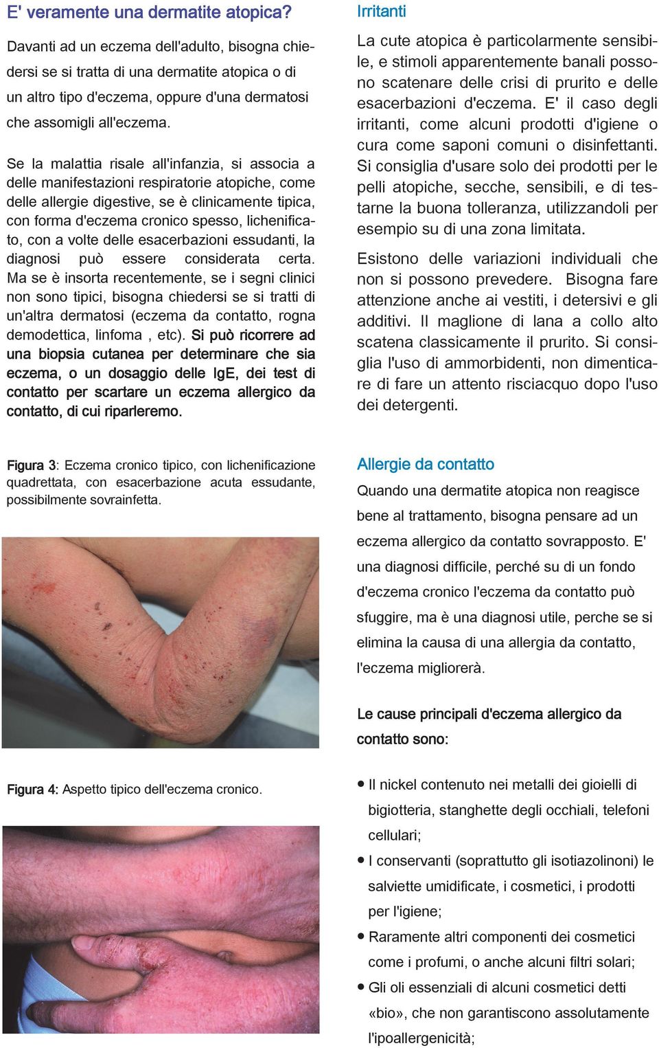 d'eczema. E' il caso degli irritanti, come alcuni prodotti d'igiene o cura come saponi comuni o disinfettanti.