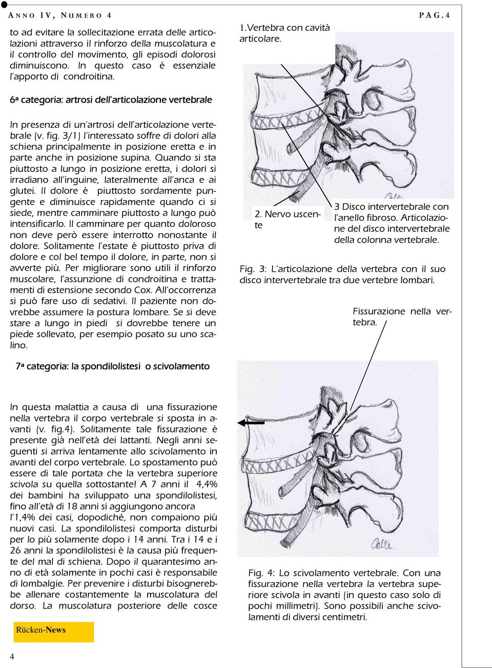 4 In presenza di un artrosi dell articolazione vertebrale (v. fig. 3/1) l interessato soffre di dolori alla schiena principalmente in posizione eretta e in parte anche in posizione supina.