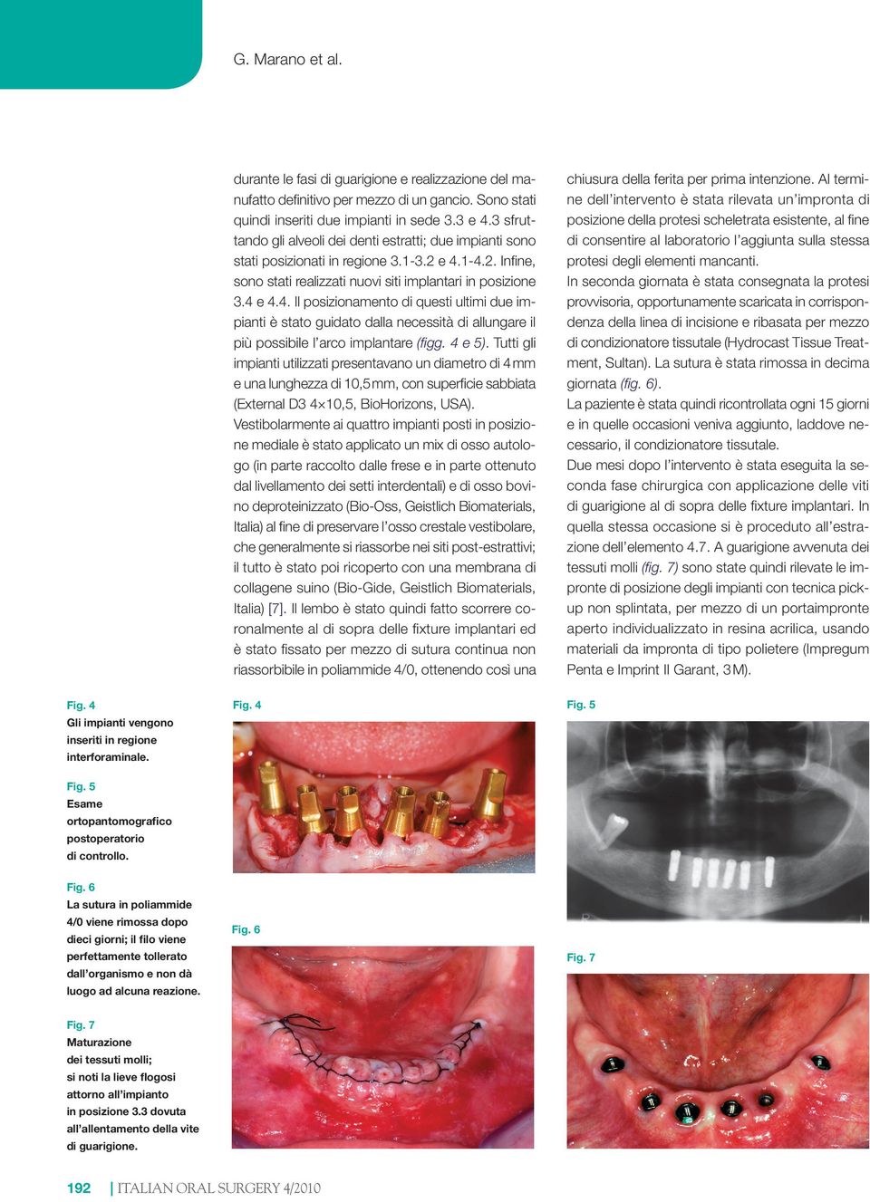 1-4.2. Infine, sono stati realizzati nuovi siti implantari in posizione 3.4 e 4.4. Il posizionamento di questi ultimi due impianti è stato guidato dalla necessità di allungare il più possibile l arco implantare (figg.