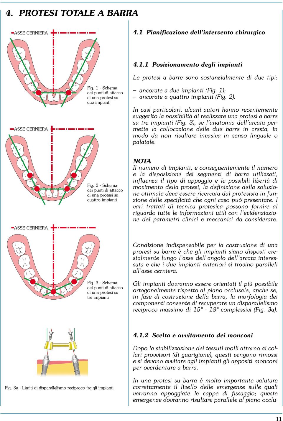 3), se l anatomia dell arcata permette la collocazione delle due barre in cresta, in modo da non risultare invasiva in senso linguale o palatale. ASSE CERNIERA Fig.