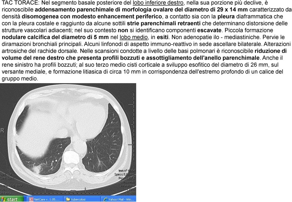 retraenti che determinano distorsione delle strutture vascolari adiacenti; nel suo contesto non si identificano componenti escavate.