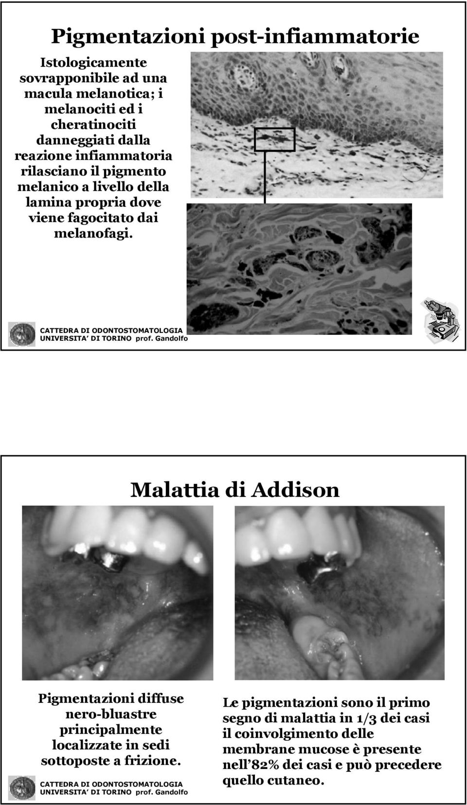 Malattia di Addison Pigmentazioni diffuse nero-bluastre principalmente localizzate in sedi sottoposte a frizione.