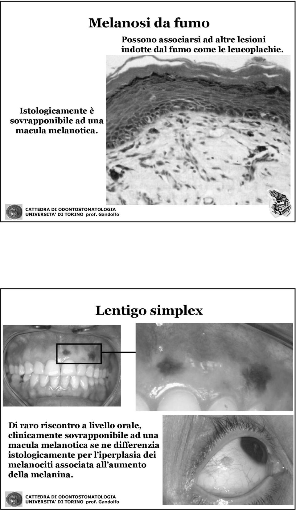 Lentigo simplex Di raro riscontro a livello orale, clinicamente sovrapponibile ad una