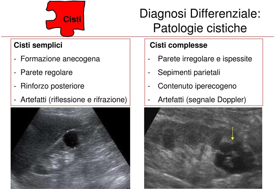 Differenziale: Patologie cistiche Cisti complesse - Parete irregolare e