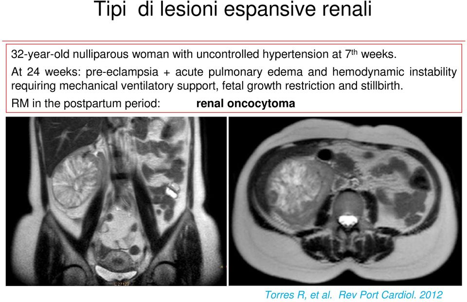 At 24 weeks: pre-eclampsia + acute pulmonary edema and hemodynamic instability requiring