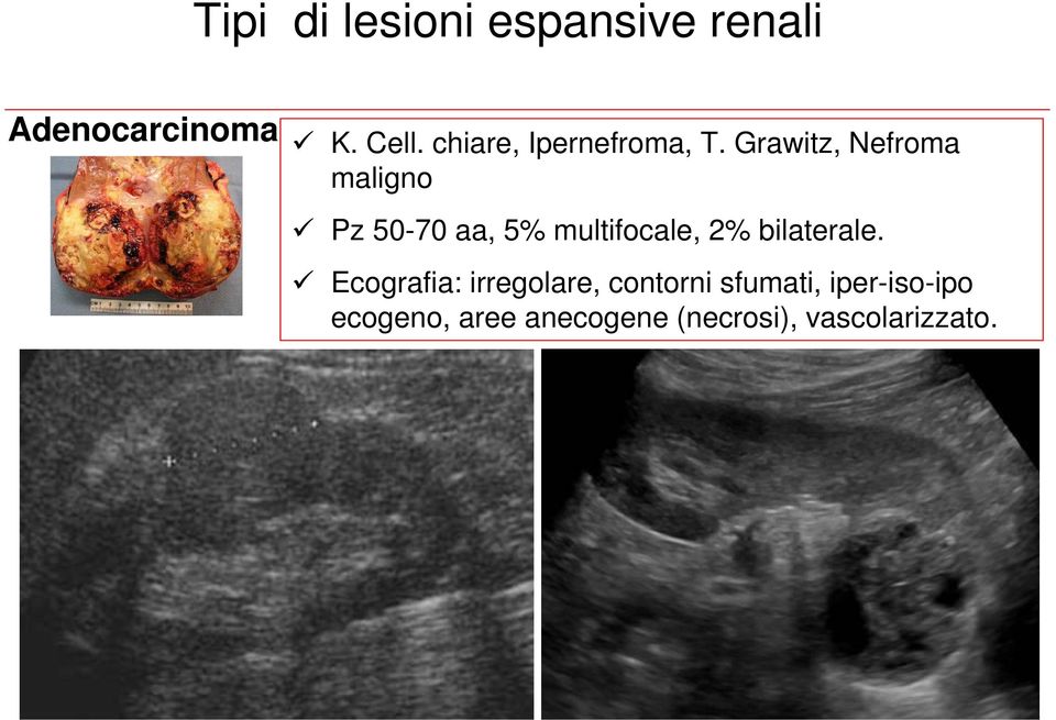 Grawitz, Nefroma maligno Pz 50-70 aa, 5% multifocale, 2%