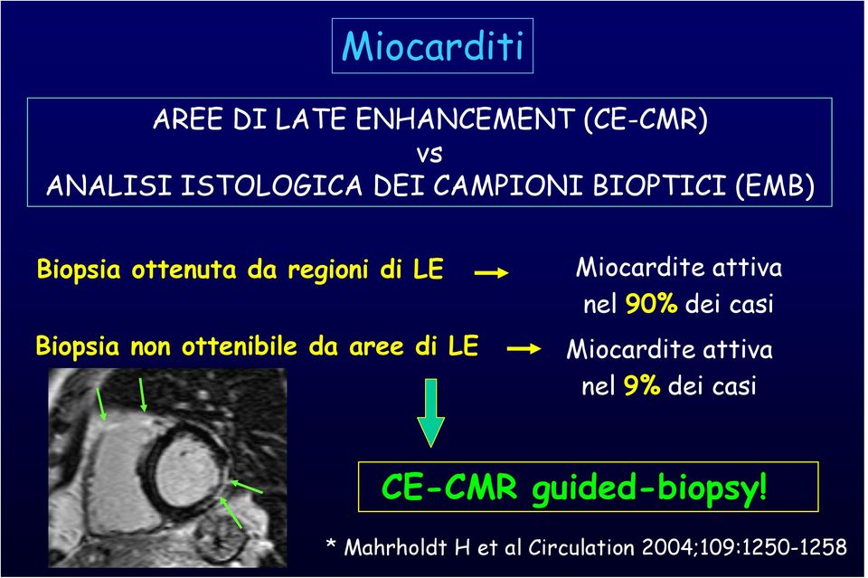 ottenibile da aree di LE Miocardite attiva nel 90% dei casi Miocardite