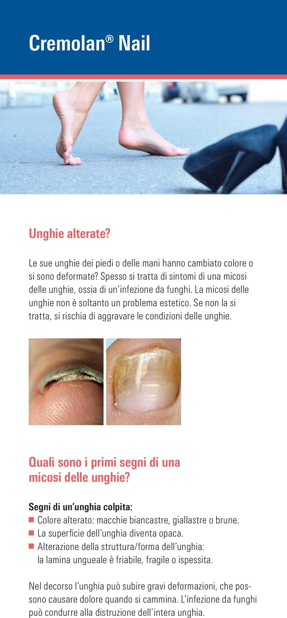 Se non la si tratta, si rischia di aggravare le condizioni delle unghie. Quali sono i primi segni di una micosi delle unghie?