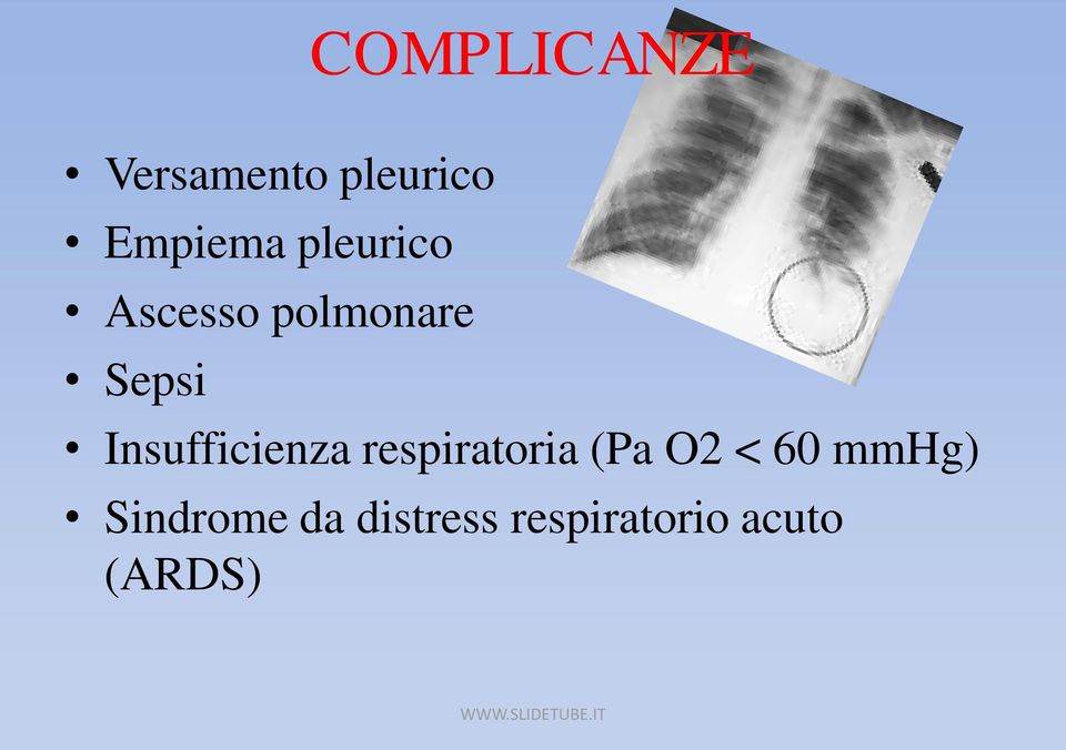 Insufficienza respiratoria (Pa O2 < 60