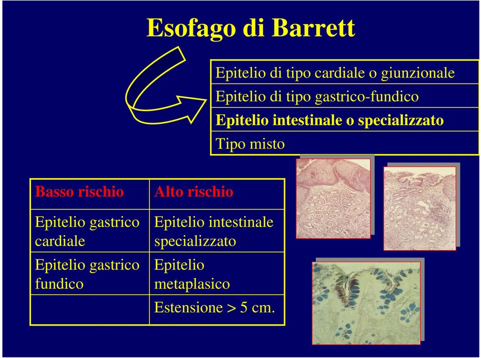 Basso rischio Epitelio gastrico cardiale Epitelio gastrico fundico Alto