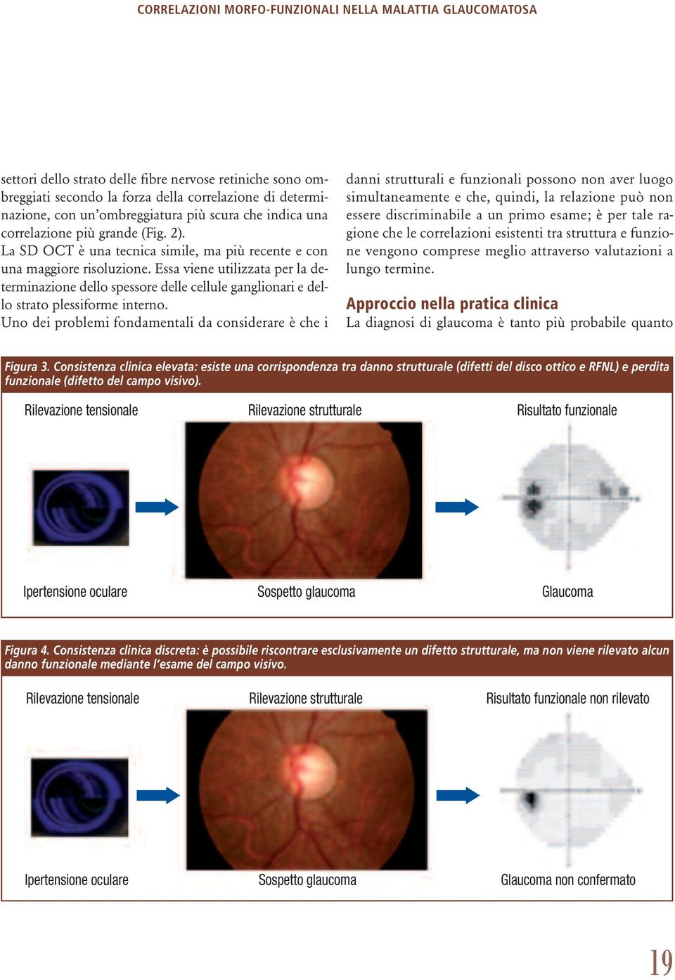 Essa viene utilizzata per la determinazione dello spessore delle cellule ganglionari e dello strato plessiforme interno.