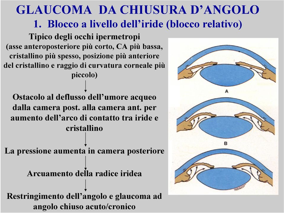 cristallino più spesso, posizione più anteriore del cristallino e raggio di curvatura corneale più piccolo) Ostacolo al deflusso dell