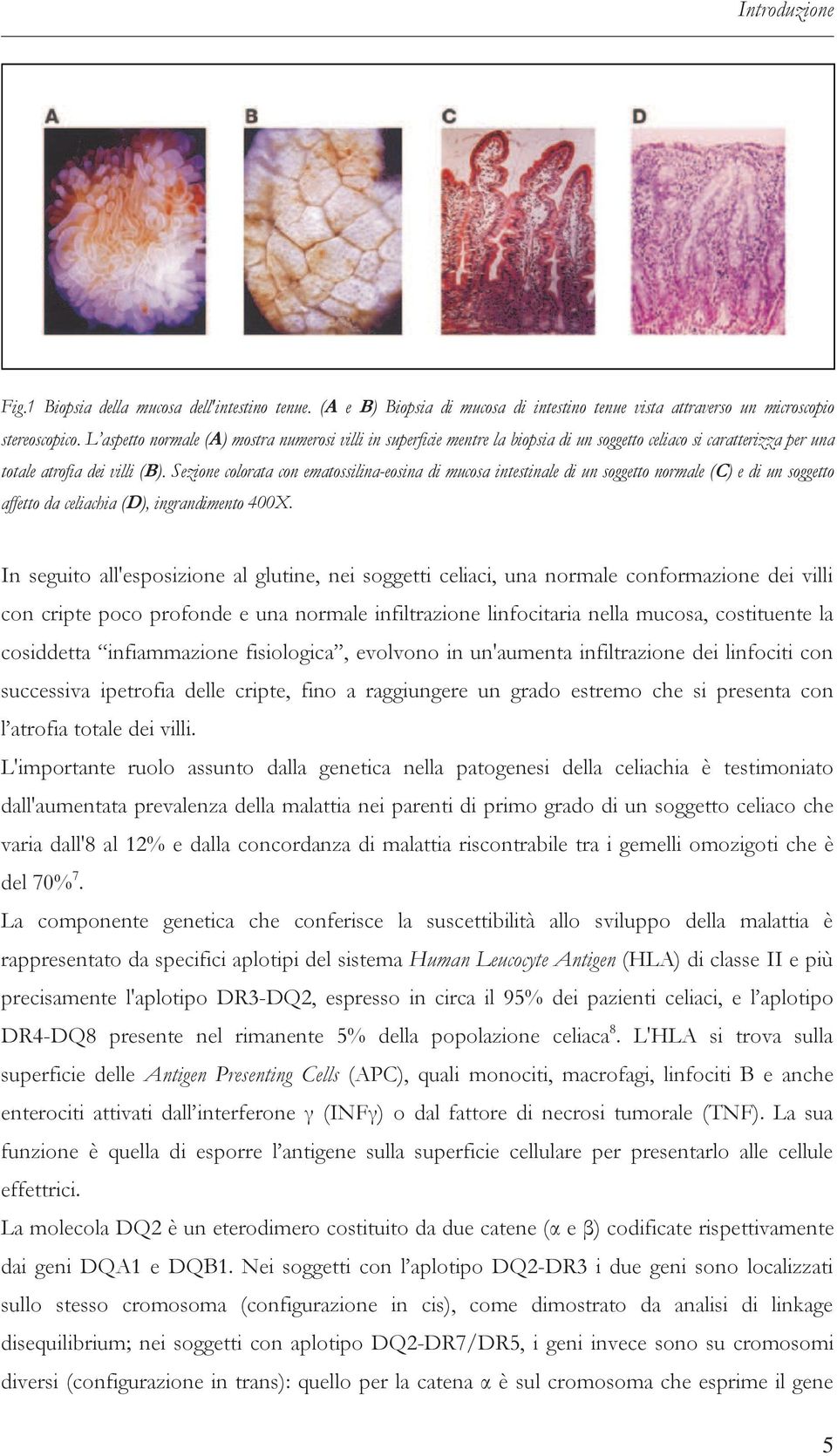 Sezione colorata con ematossilina-eosina di mucosa intestinale di un soggetto normale (C) e di un soggetto affetto da celiachia (D), ingrandimento 400X.