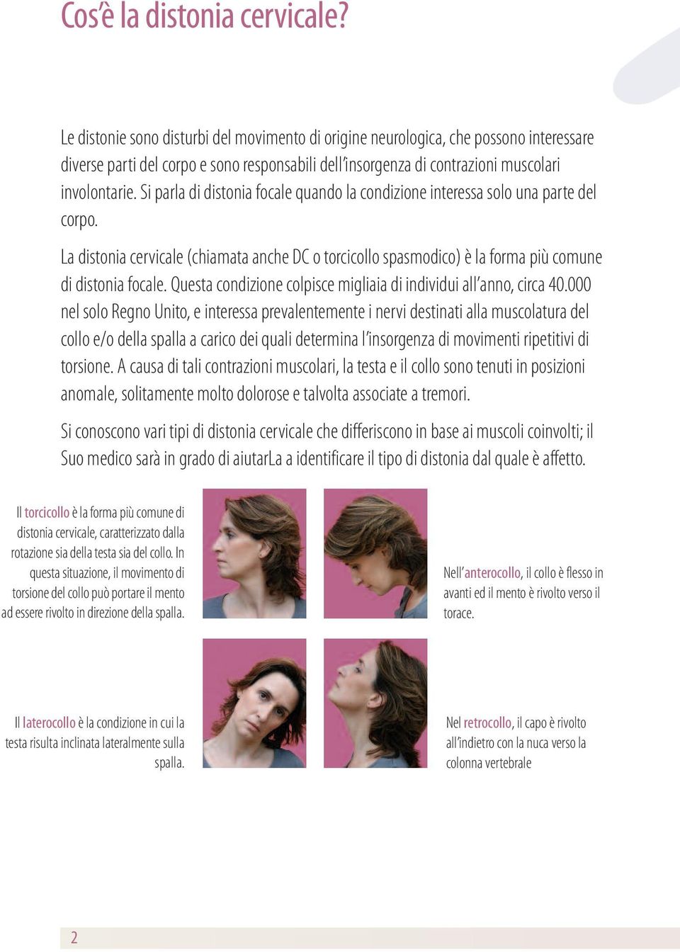 Si parla di distonia focale quando la condizione interessa solo una parte del corpo. La distonia cervicale (chiamata anche DC o torcicollo spasmodico) è la forma più comune di distonia focale.