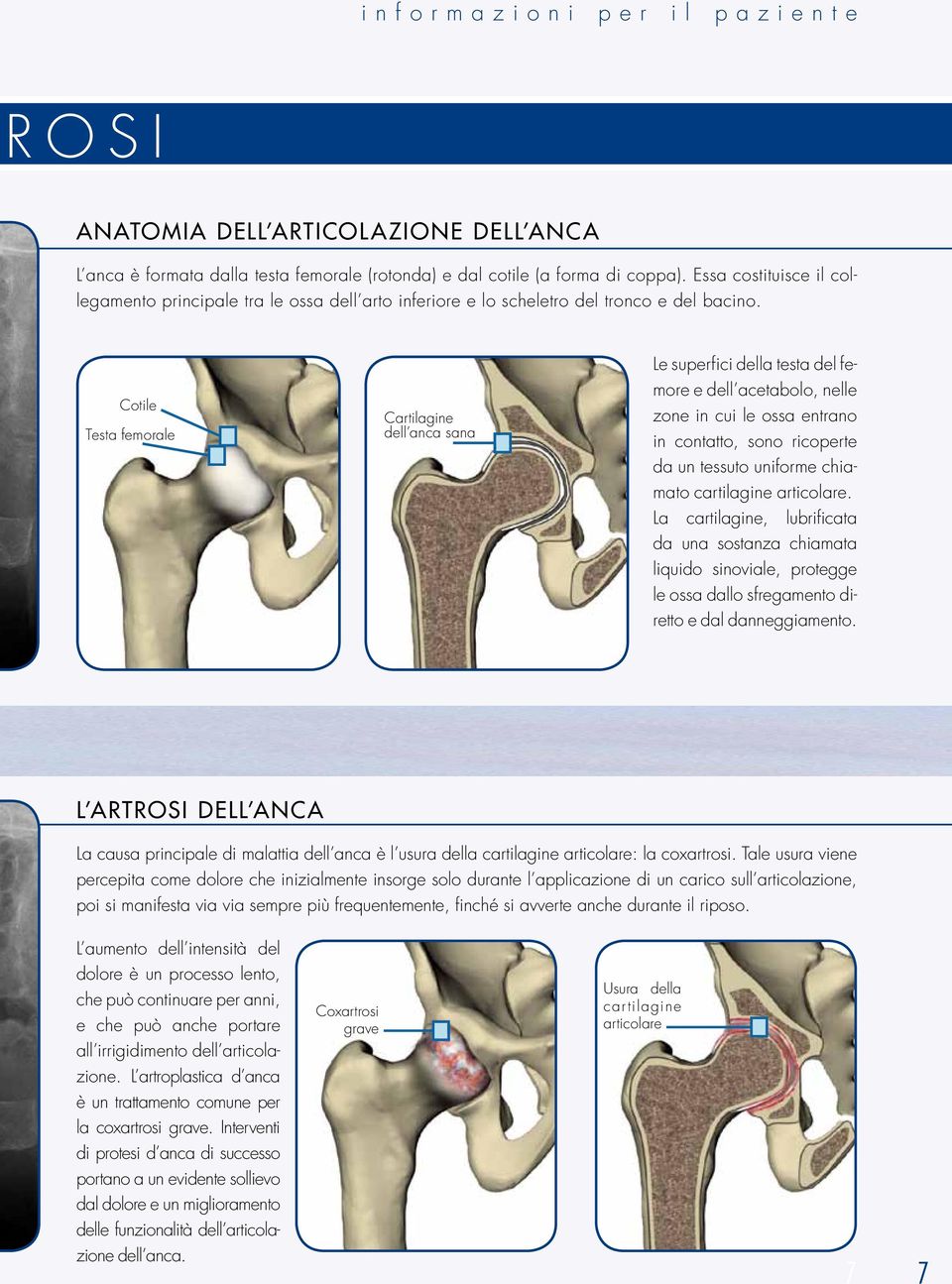 Cotile Testa femorale Cartilagine dell anca sana Le superfici della testa del femore e dell acetabolo, nelle zone in cui le ossa entrano in contatto, sono ricoperte da un tessuto uniforme chiamato