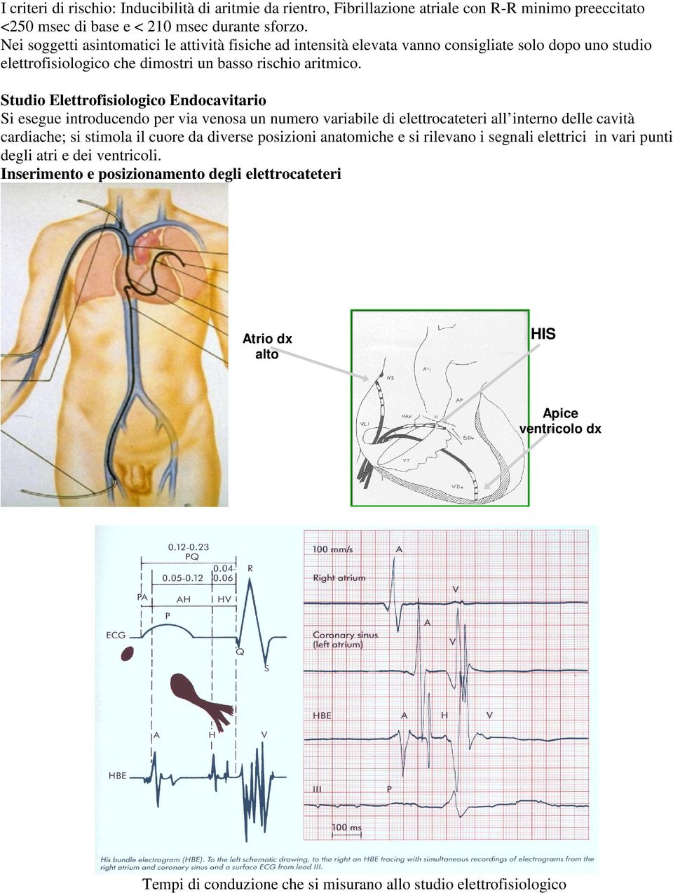 Studio Elettrofisiologico Endocavitario Si esegue introducendo per via venosa un numero variabile di elettrocateteri all interno delle cavità cardiache; si stimola il cuore da diverse