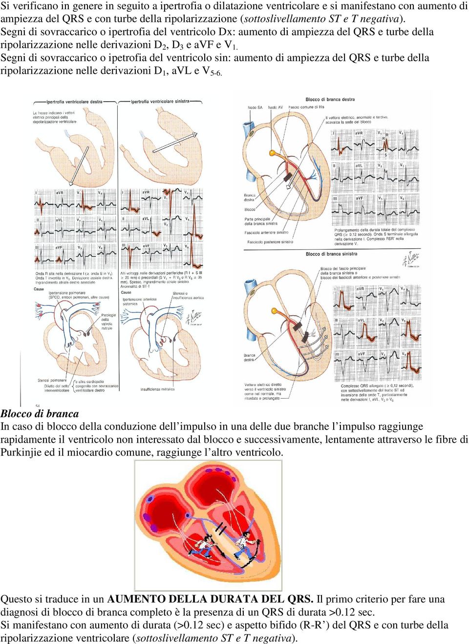 Segni di sovraccarico o ipetrofia del ventricolo sin: aumento di ampiezza del QRS e turbe della ripolarizzazione nelle derivazioni D 1, avl e V 5-6.