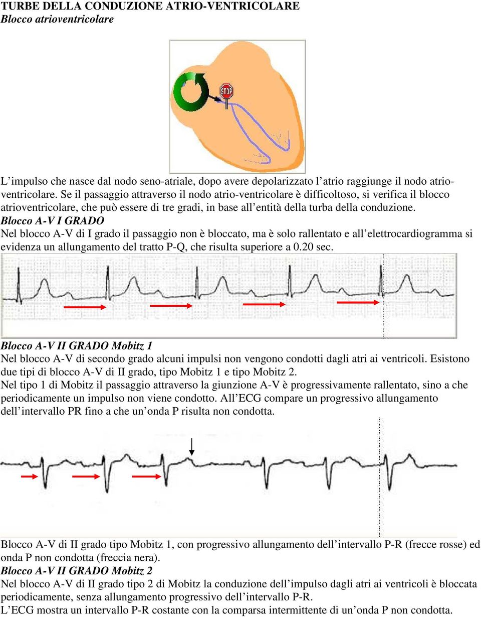 Blocco A-V I GRADO Nel blocco A-V di I grado il passaggio non è bloccato, ma è solo rallentato e all elettrocardiogramma si evidenza un allungamento del tratto P-Q, che risulta superiore a 0.20 sec.