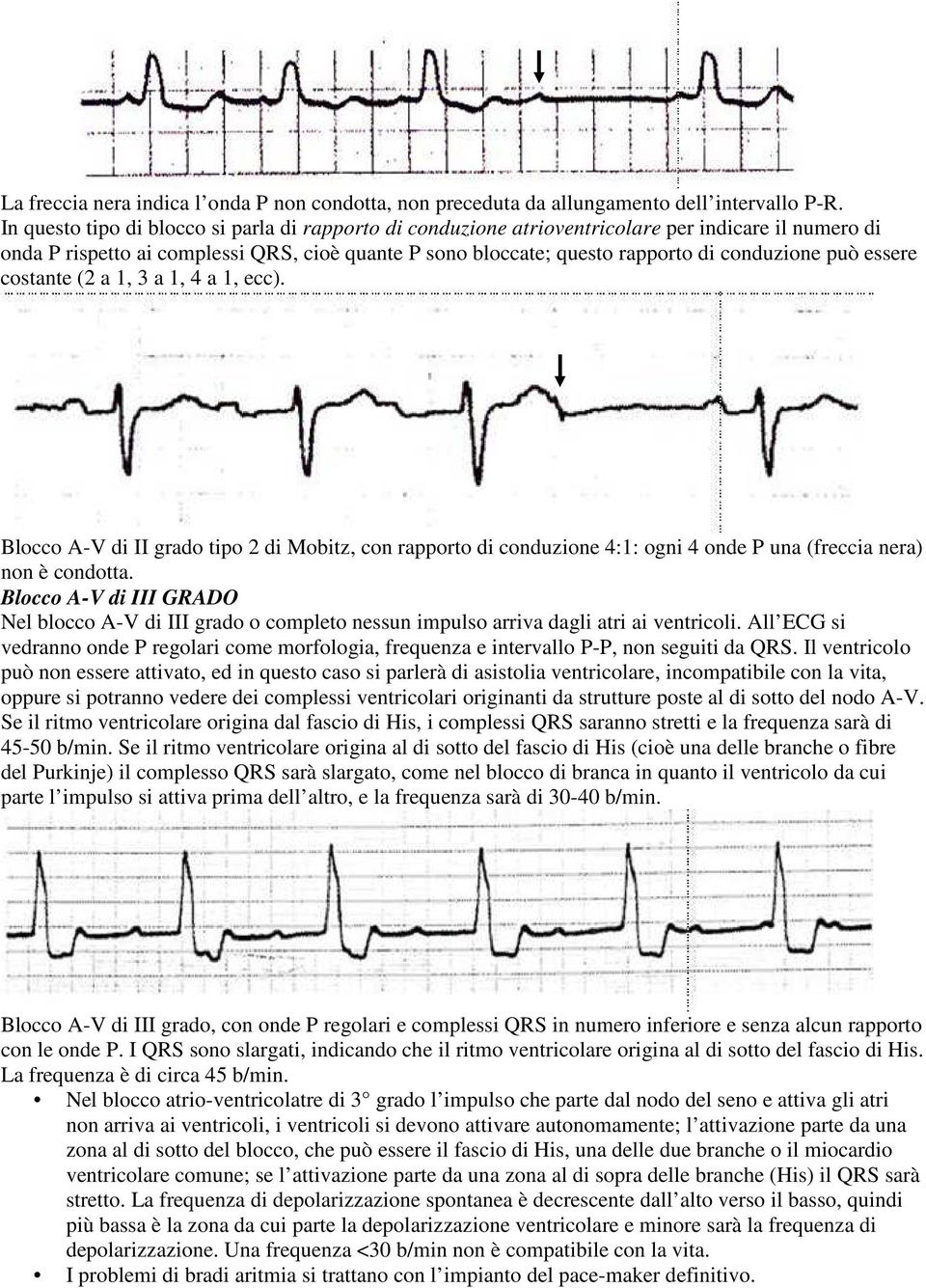 può essere costante (2 a 1, 3 a 1, 4 a 1, ecc). Blocco A-V di II grado tipo 2 di Mobitz, con rapporto di conduzione 4:1: ogni 4 onde P una (freccia nera) non è condotta.