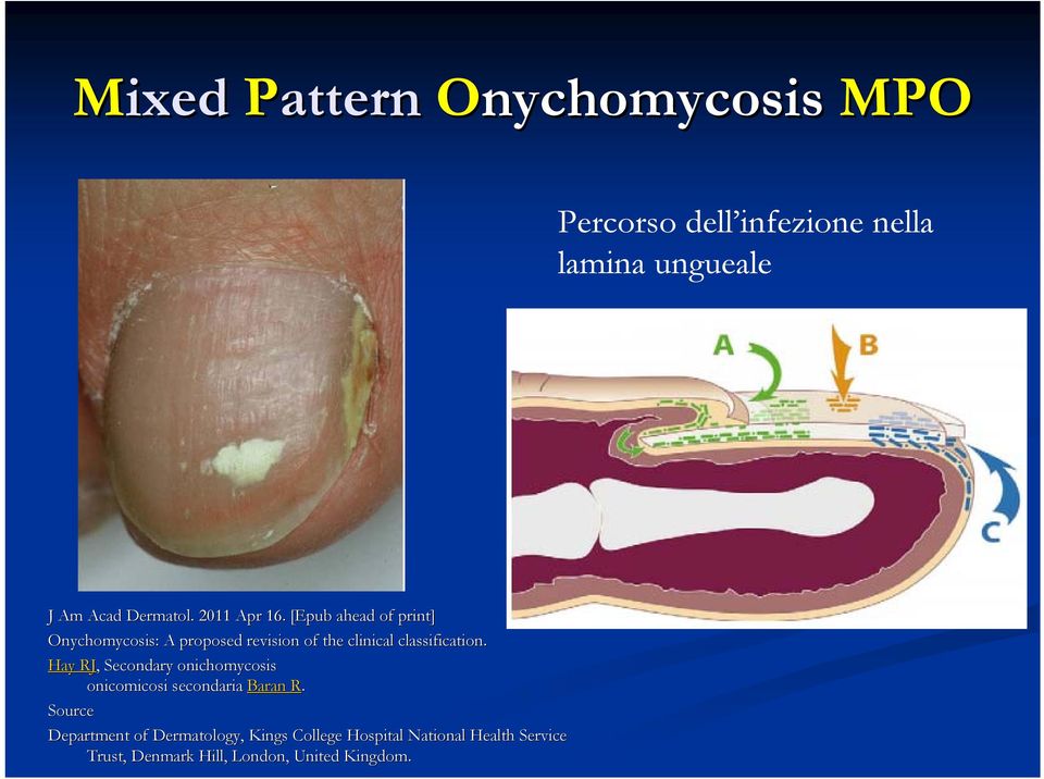 [Epub ahead of print] Onychomycosis: A proposed revision of the clinical classification.