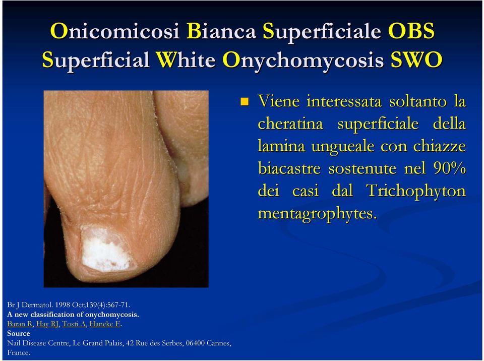 Trichophyton mentagrophytes. Br J Dermatol. 1998 Oct;139(4):567-71. A new classification of onychomycosis.