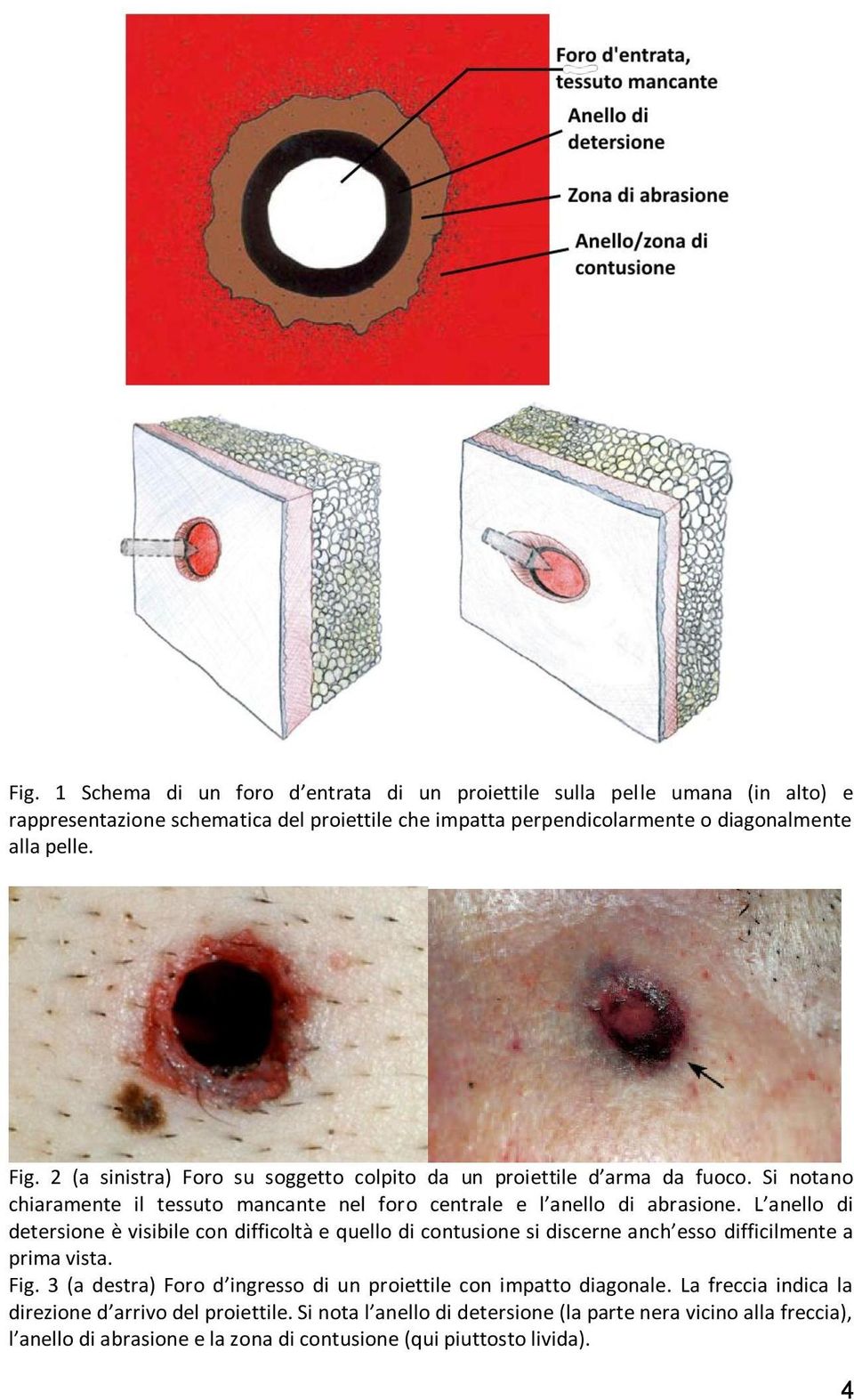 L anello di detersione è visibile con difficoltà e quello di contusione si discerne anch esso difficilmente a prima vista. Fig.