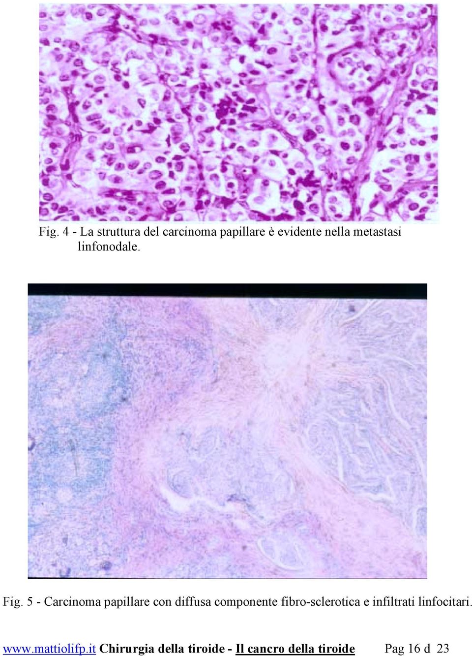 5 - Carcinoma papillare con diffusa componente fibro-sclerotica