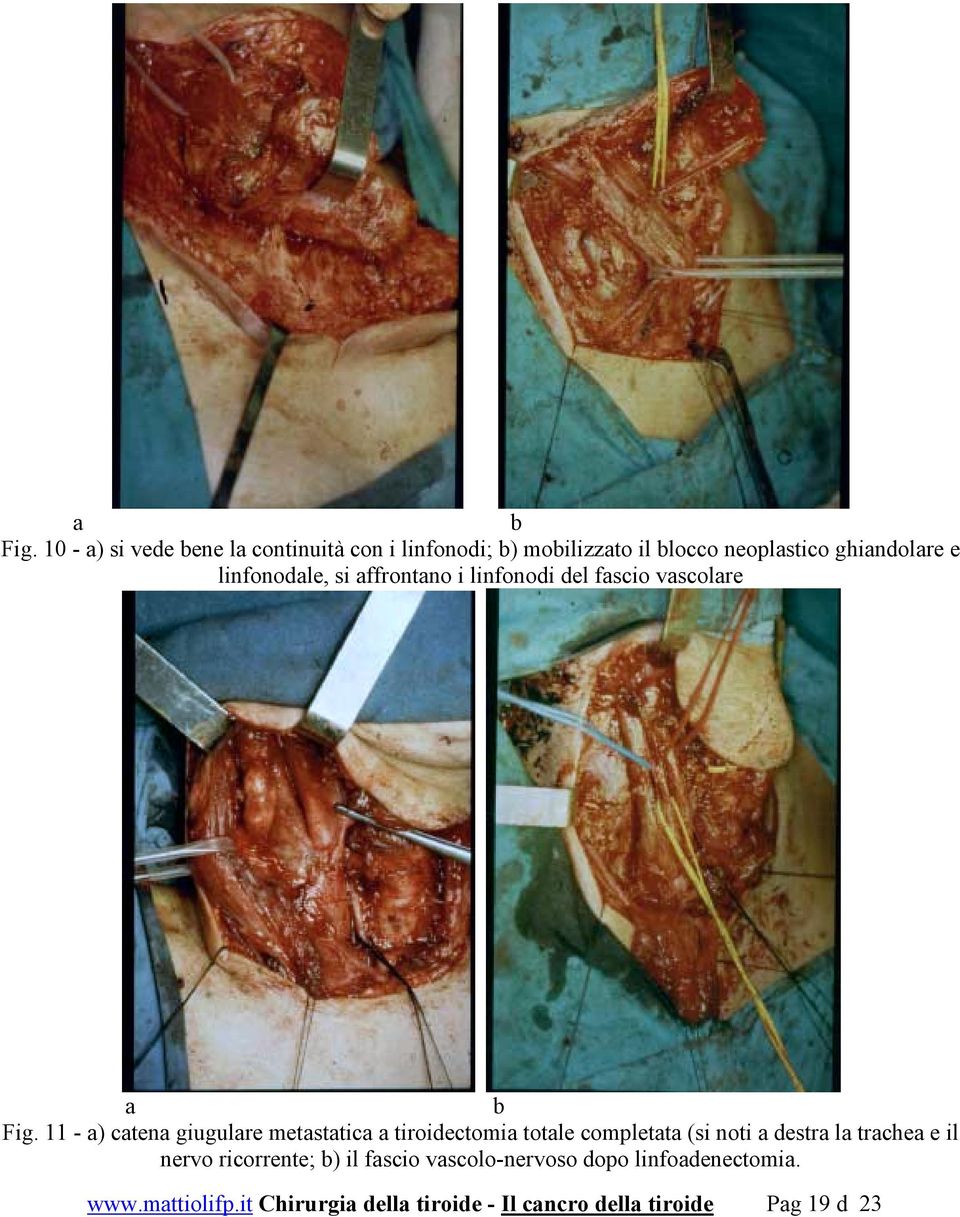 linfonodale, si affrontano i linfonodi del fascio vascolare  11 - a) catena giugulare metastatica a