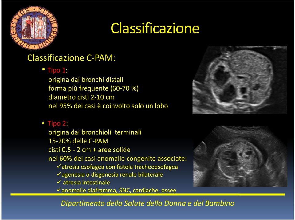 delle C-PAM cisti 0,5-2 cm + aree solide nel 60% dei casi anomalie congenite associate: atresia esofagea con