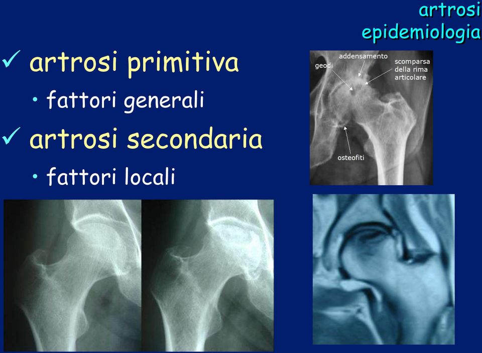 artrosi epidemiologia