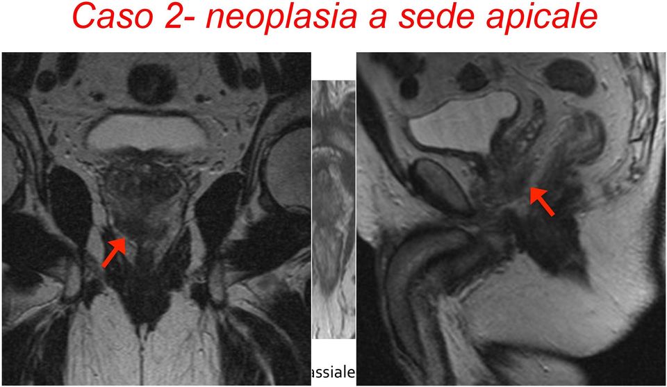 sede apicale