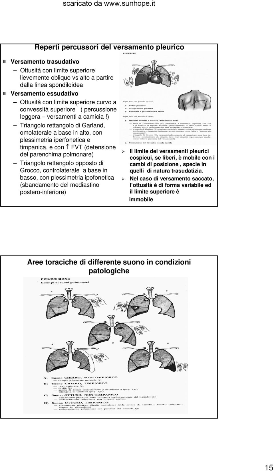 ) Triangolo rettangolo di Garland, omolaterale a base in alto, con plessimetria iperfonetica e timpanica, e con FVT (detensione del parenchima polmonare) Triangolo rettangolo opposto di Grocco,