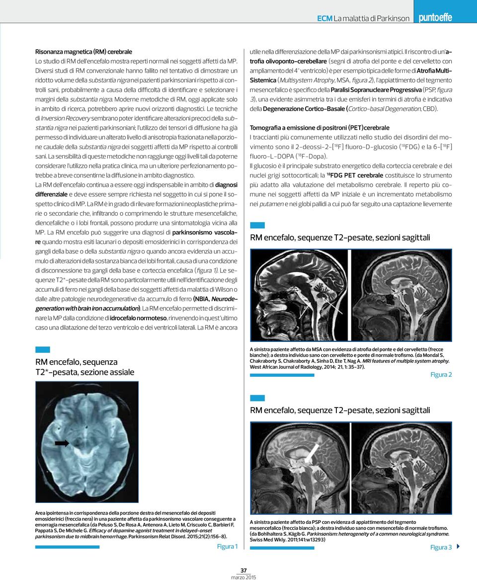 difficoltà di identificare e selezionare i margini della substantia nigra. Moderne metodiche di RM, oggi applicate solo in ambito di ricerca, potrebbero aprire nuovi orizzonti diagnostici.