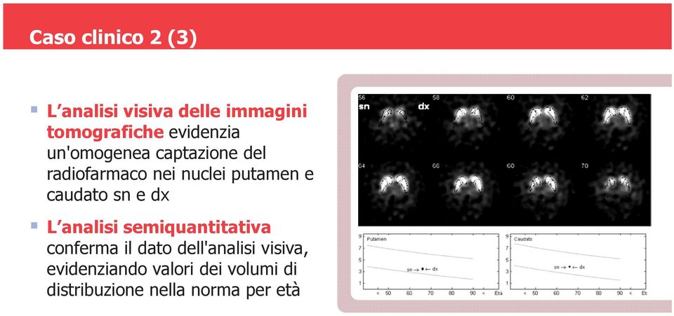 caudato sn e dx L analisi semiquantitativa conferma il dato