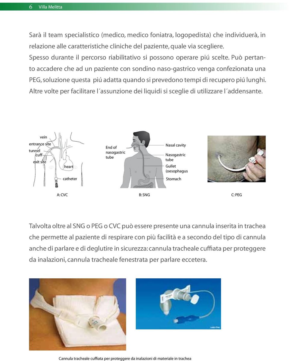 Può pertanto accadere che ad un paziente con sondino naso-gastrico venga confezionata una PEG, soluzione questa piú adatta quando si prevedono tempi di recupero piú lunghi.