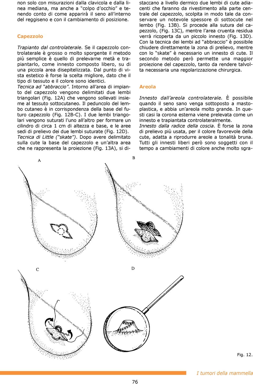 Se il capezzolo controlaterale grosso o molto sporgente il metodo pi semplice quello di prelevarne metˆ e trapiantarlo, come innesto composto libero, su di una piccola area disepitelizzata.