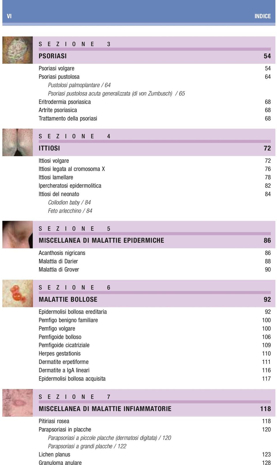 neonato 84 Collodion baby / 84 Feto arlecchino / 84 S E Z I O N E 5 MISCELLANEA DI MALATTIE EPIDERMICHE 86 Acanthosis nigricans 86 Malattia di Darier 88 Malattia di Grover 90 S E Z I O N E 6 MALATTIE