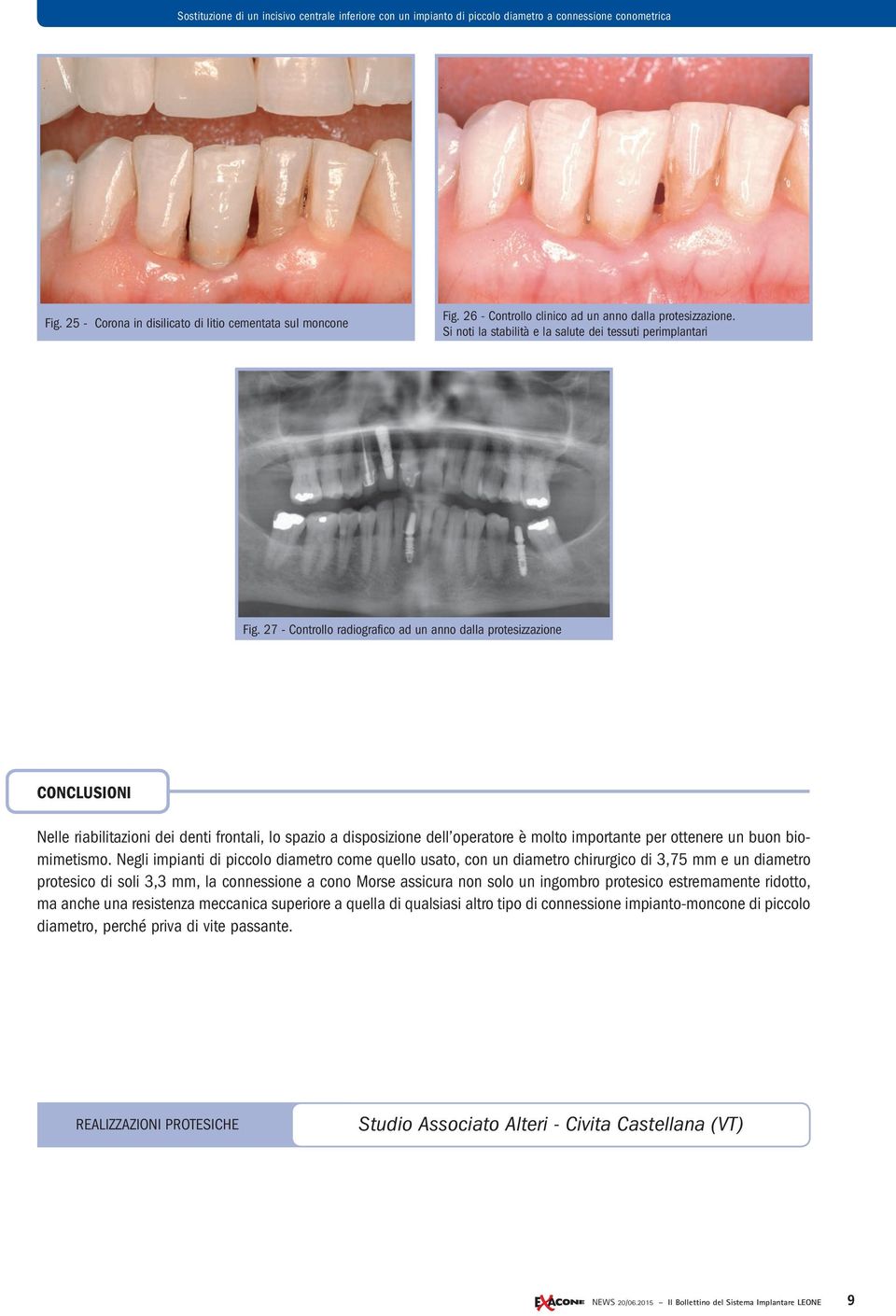 27 - Controllo radiografico ad un anno dalla protesizzazione CONCLUSIONI Nelle riabilitazioni dei denti frontali, lo spazio a disposizione dell operatore è molto importante per ottenere un buon