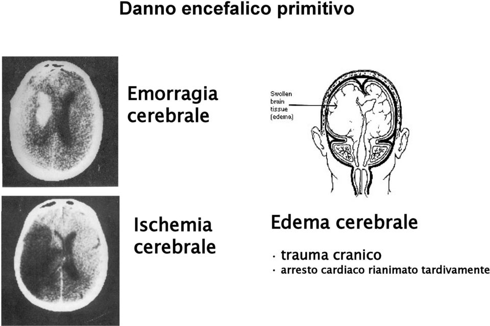cerebrale Edema cerebrale trauma