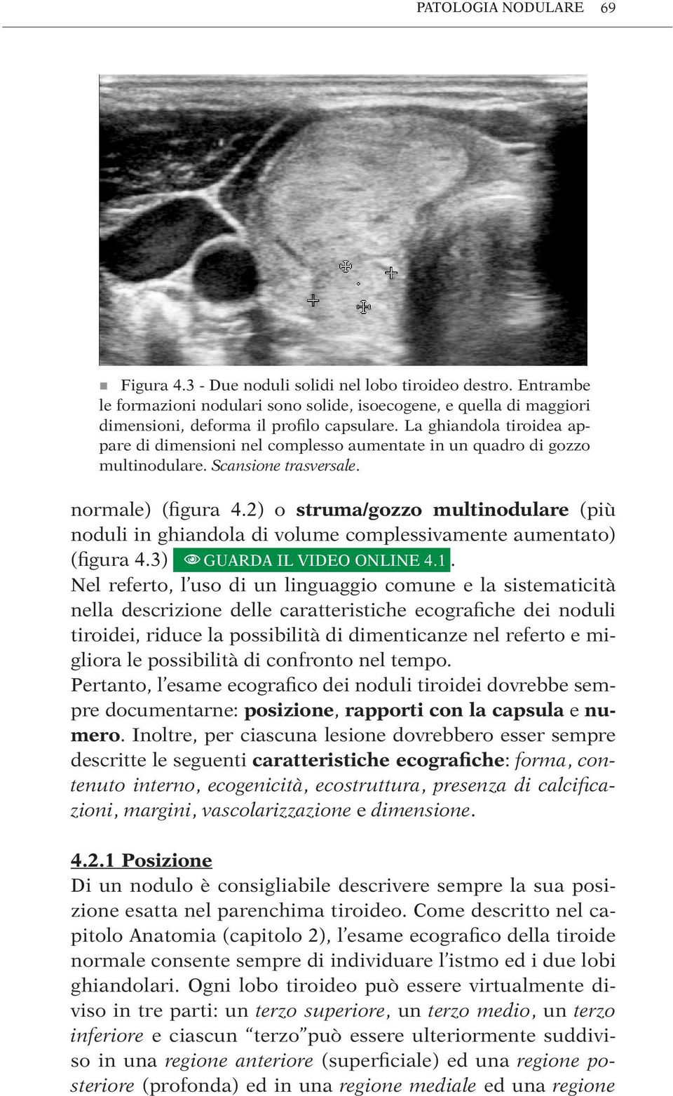 2) o struma/gozzo multinodulare (più noduli in ghiandola di volume complessivamente aumentato) (figura 4.3) guarda il video online 4.1.