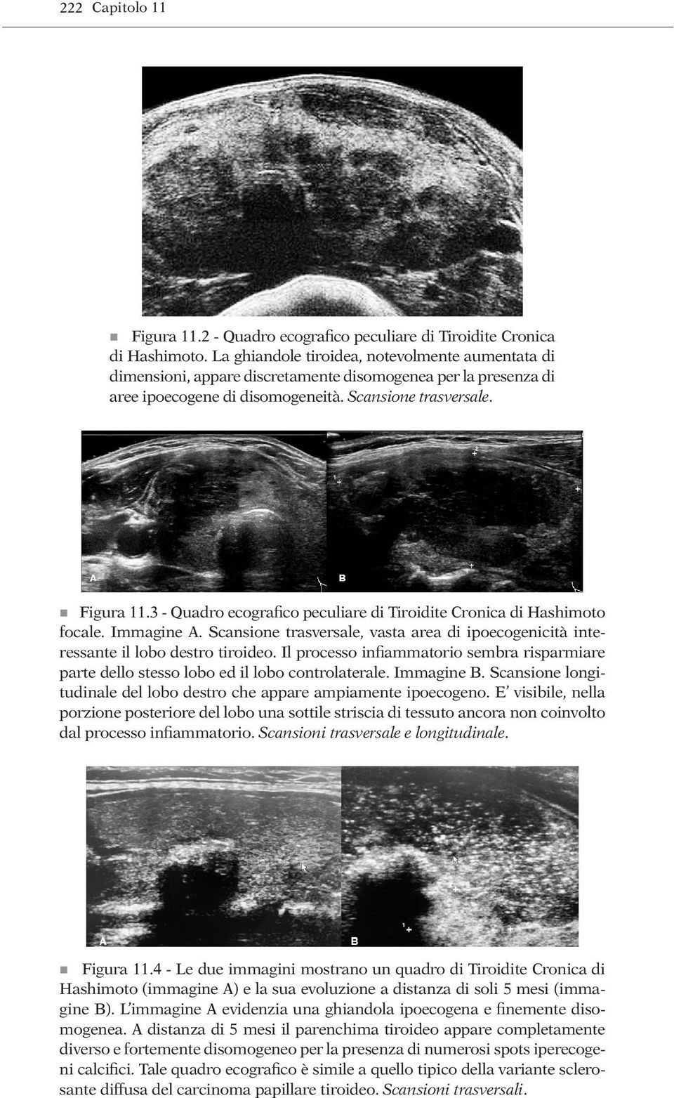 3 - Quadro ecografico peculiare di Tiroidite Cronica di Hashimoto focale. Immagine A. Scansione trasversale, vasta area di ipoecogenicità interessante il lobo destro tiroideo.
