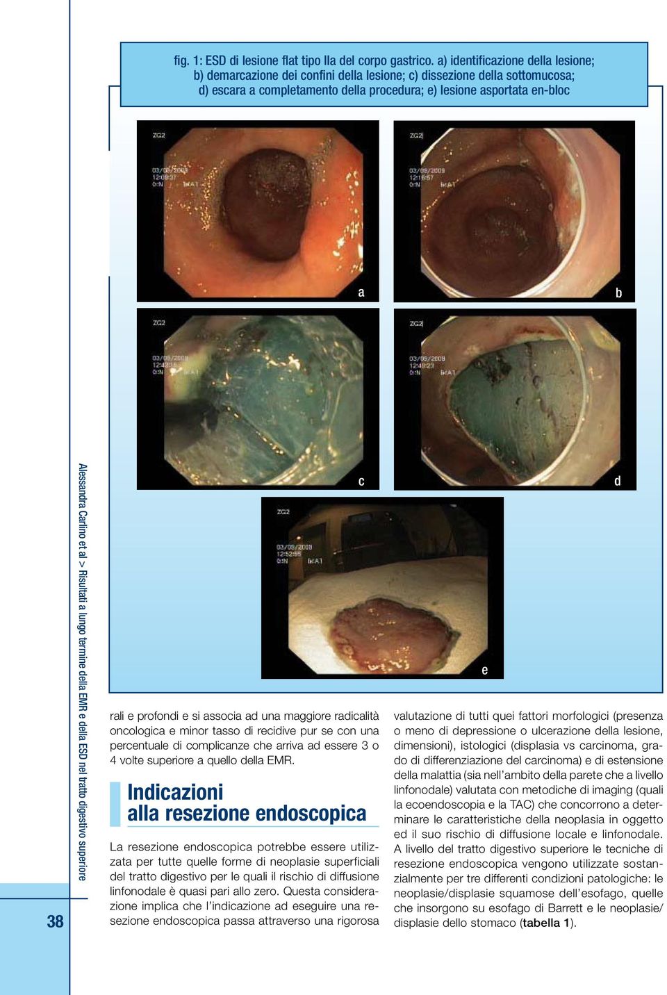 Carlino et al > Risultati a lungo termine della EMR e della ESD nel tratto digestivo superiore rali e profondi e si associa ad una maggiore radicalità oncologica e minor tasso di recidive pur se con