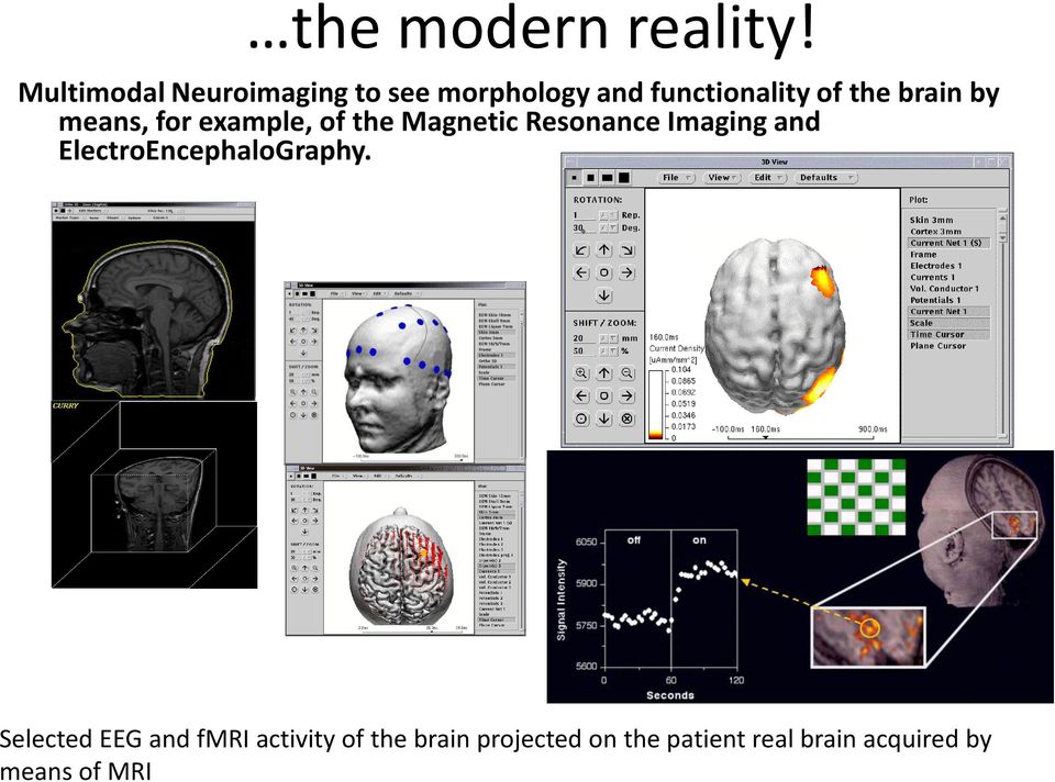 brain by means, for example, of the Magnetic Resonance Imaging and