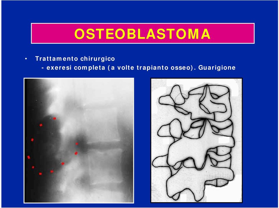 - exeresi completa (a